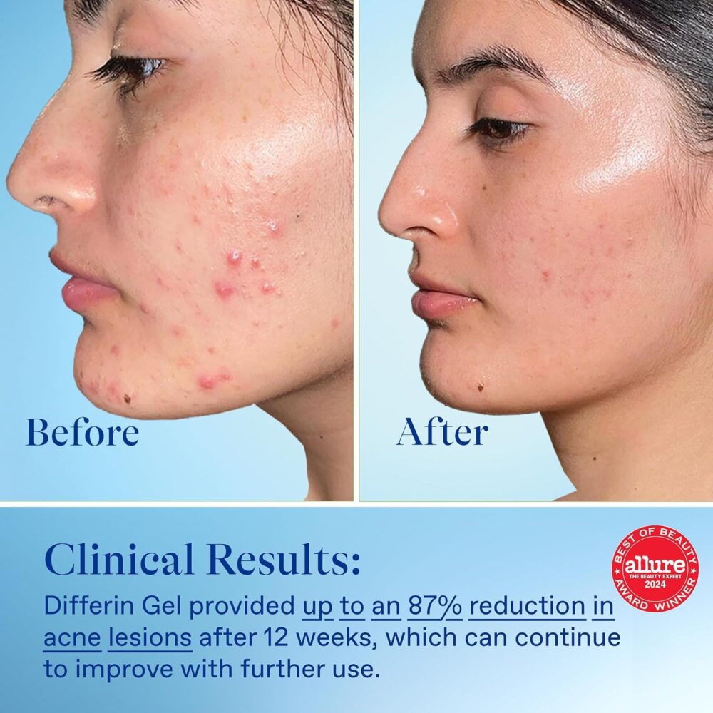 Differin Acne Treatment Gel – 0.1% Adapalene, 90‑Day Supply (1 oz Pump Tube) - Image 2